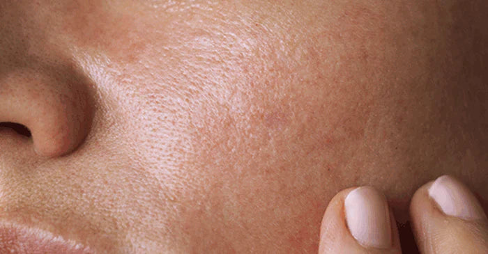 Gentle Skincare for Dry Skin: Hydrate and Soothe for Lasting Comfort